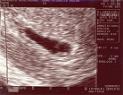 2007-11-26 Josh Ultrasound